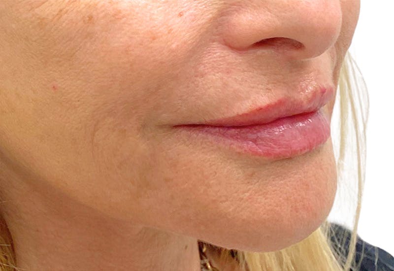 Filler Before & After Gallery - Patient 227662 - Image 2