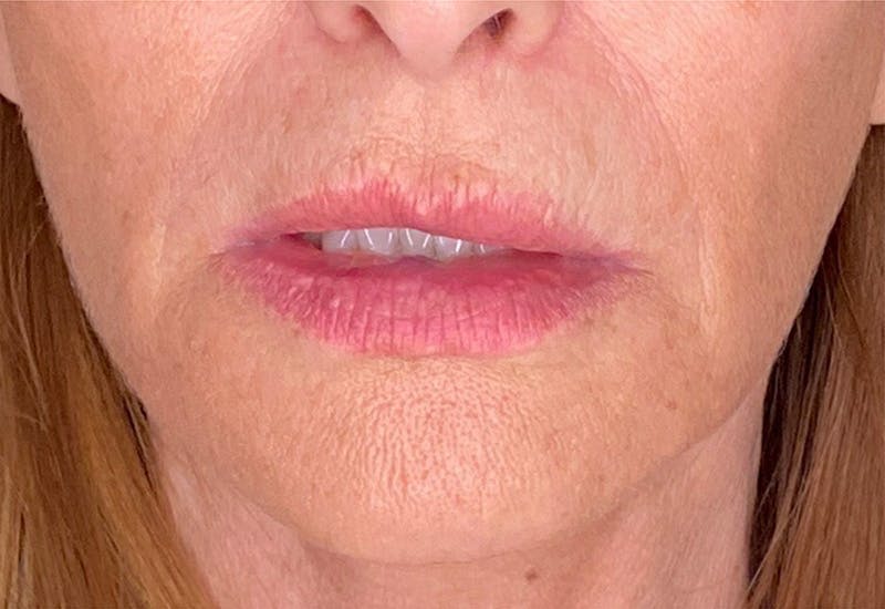 Filler Before & After Gallery - Patient 227662 - Image 3