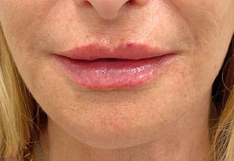 Filler Before & After Gallery - Patient 227662 - Image 4