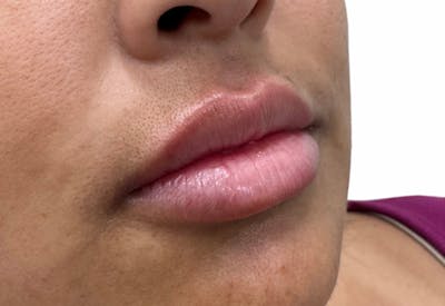 Filler Before & After Gallery - Patient 355270 - Image 1