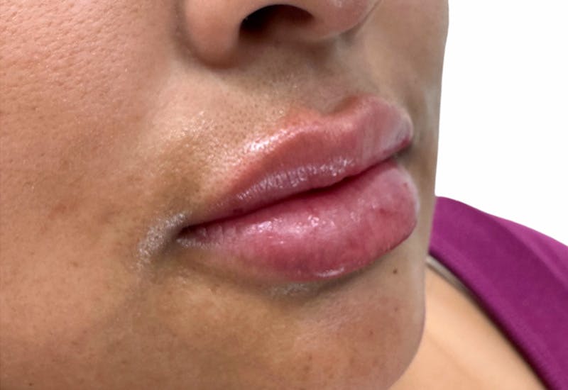Filler Before & After Gallery - Patient 355270 - Image 2