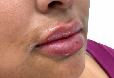 Filler Before & After Gallery - Patient 355270 - Image 2