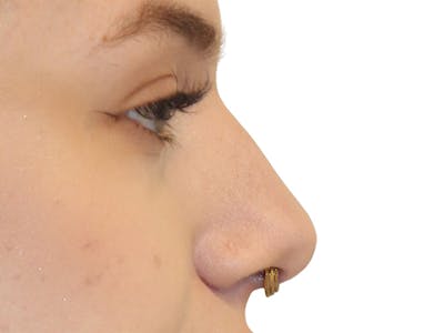 Filler Before & After Gallery - Patient 831782 - Image 1