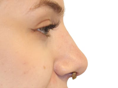 Filler Before & After Gallery - Patient 831782 - Image 2