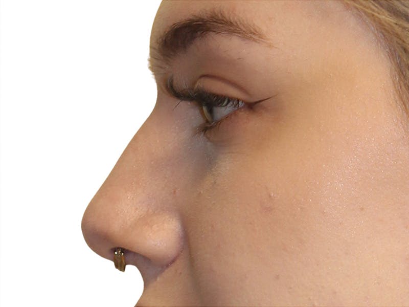 Filler Before & After Gallery - Patient 831782 - Image 3