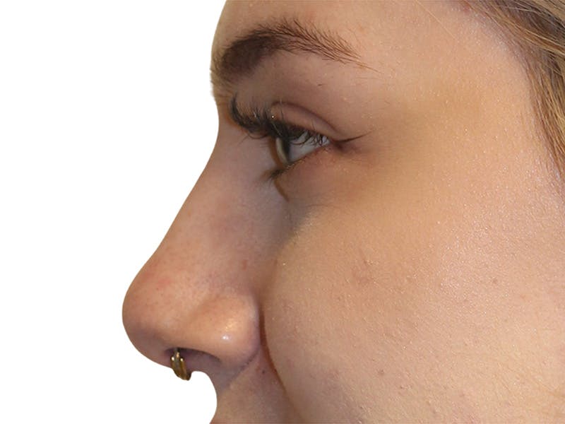 Filler Before & After Gallery - Patient 831782 - Image 4