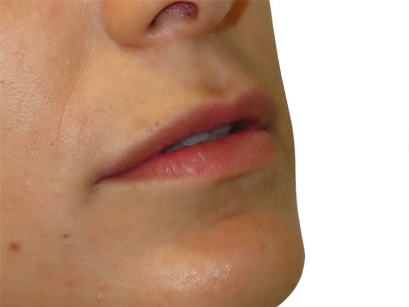 Filler Before & After Gallery - Patient 404387 - Image 1