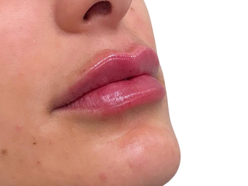 Filler Before & After Gallery - Patient 404387 - Image 2