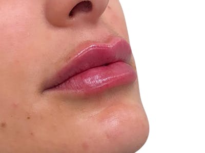 Filler Before & After Gallery - Patient 404387 - Image 2