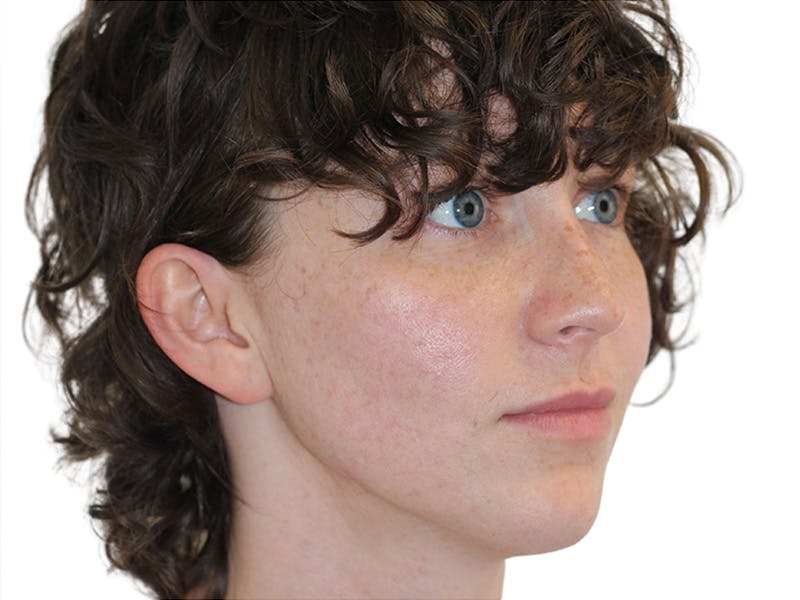 Filler Before & After Gallery - Patient 682566 - Image 1