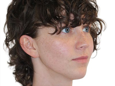 Filler Before & After Gallery - Patient 682566 - Image 1