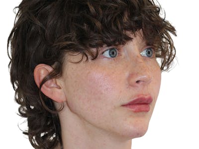 Filler Before & After Gallery - Patient 682566 - Image 2