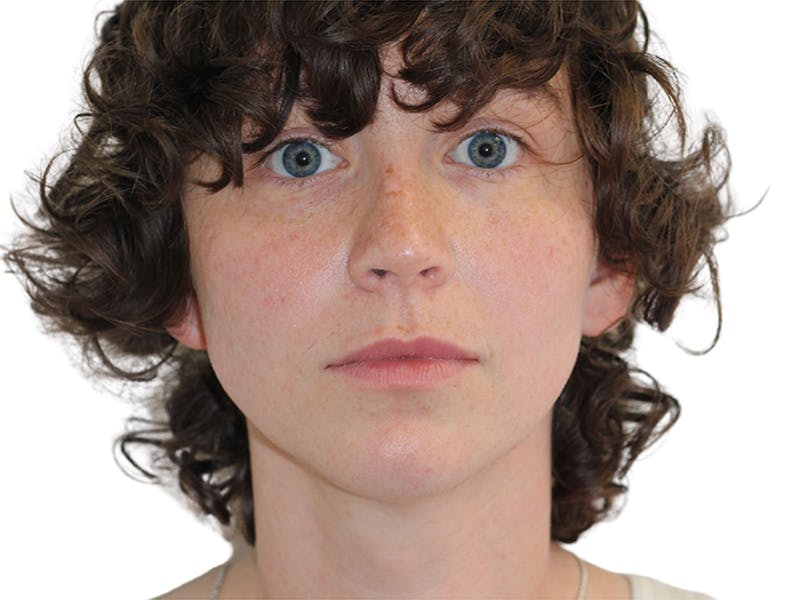 Filler Before & After Gallery - Patient 682566 - Image 3