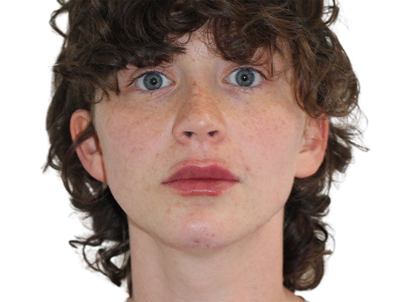 Filler Before & After Gallery - Patient 682566 - Image 4