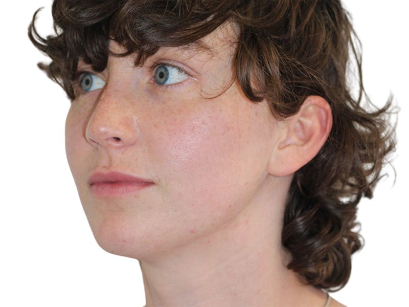 Filler Before & After Gallery - Patient 682566 - Image 5