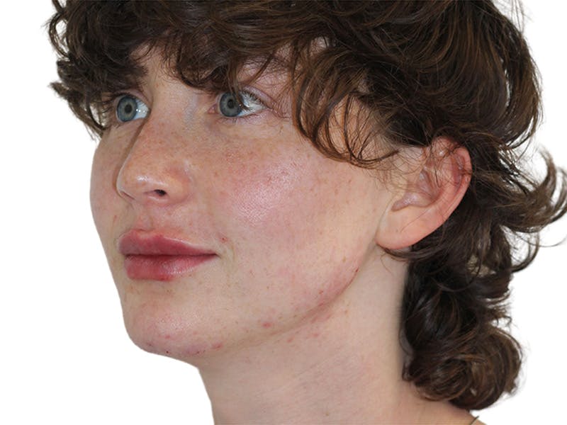 Filler Before & After Gallery - Patient 682566 - Image 6