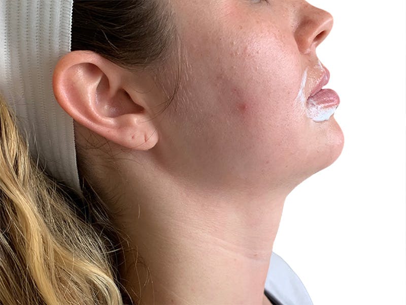 Filler Before & After Gallery - Patient 680529 - Image 1