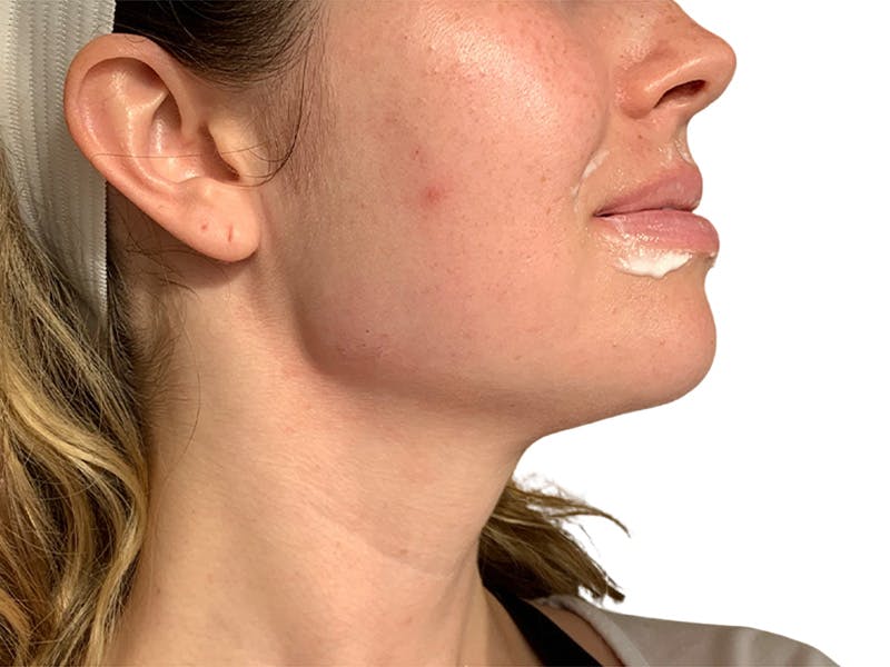 Filler Before & After Gallery - Patient 680529 - Image 2