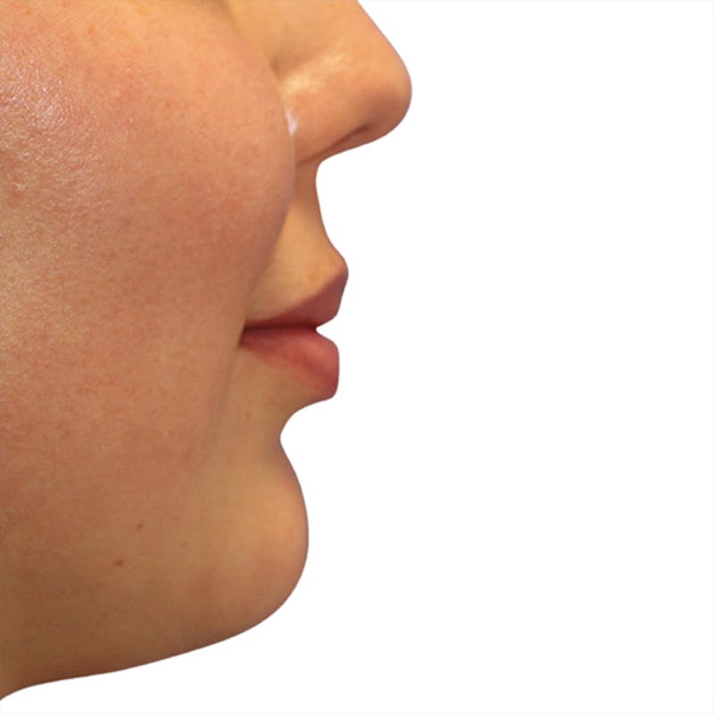 Filler Before & After Gallery - Patient 992763 - Image 1