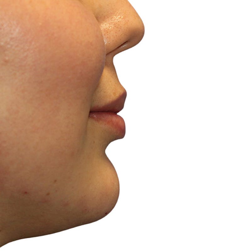 Filler Before & After Gallery - Patient 992763 - Image 2