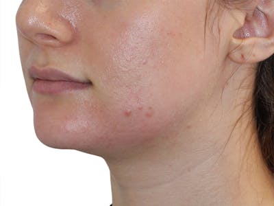 Filler Before & After Gallery - Patient 184462 - Image 1