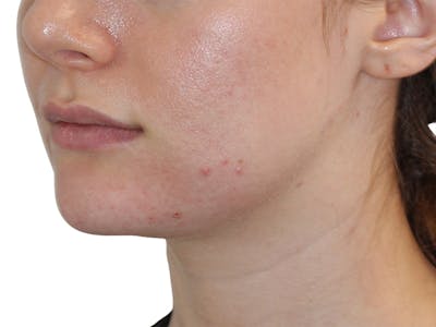 Filler Before & After Gallery - Patient 184462 - Image 2