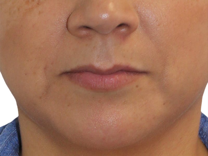 Filler Before & After Gallery - Patient 157882 - Image 1