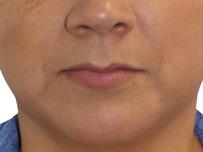 Filler Before & After Gallery - Patient 157882 - Image 1