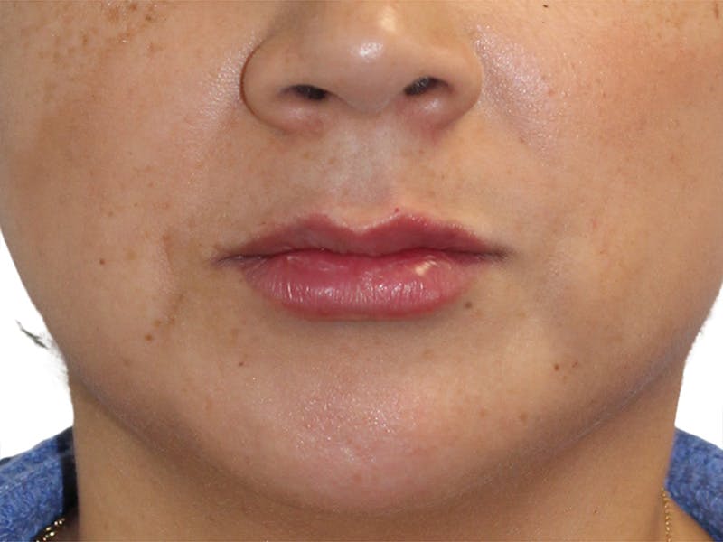 Filler Before & After Gallery - Patient 157882 - Image 2