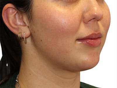 Filler Before & After Gallery - Patient 350256 - Image 1
