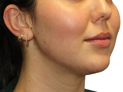 Filler Before & After Gallery - Patient 350256 - Image 2