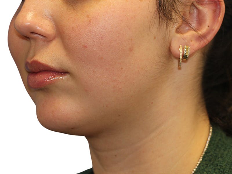 Filler Before & After Gallery - Patient 350256 - Image 3