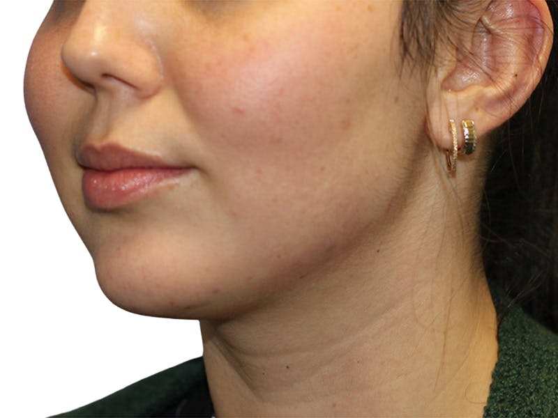 Filler Before & After Gallery - Patient 350256 - Image 4