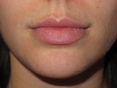 Filler Before & After Gallery - Patient 166536 - Image 1