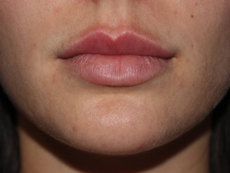 Filler Before & After Gallery - Patient 166536 - Image 2