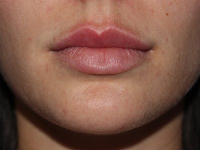 Filler Before & After Gallery - Patient 166536 - Image 2