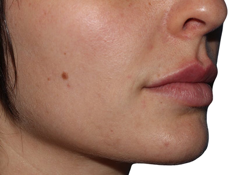 Filler Before & After Gallery - Patient 166536 - Image 3