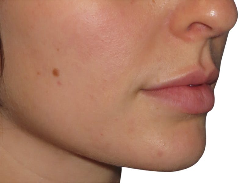 Filler Before & After Gallery - Patient 166536 - Image 4