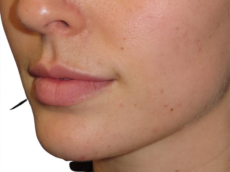 Filler Before & After Gallery - Patient 166536 - Image 5