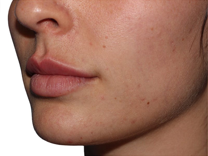 Filler Before & After Gallery - Patient 166536 - Image 6