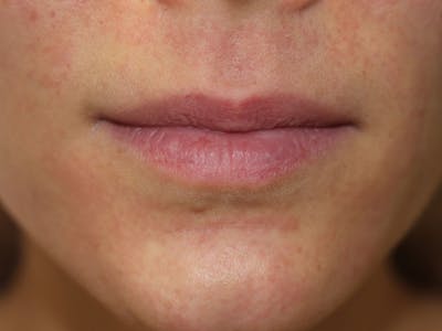 Filler Before & After Gallery - Patient 925699 - Image 1