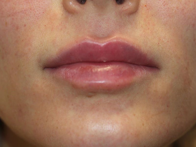 Filler Before & After Gallery - Patient 925699 - Image 2