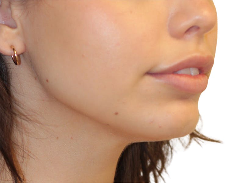 Filler Before & After Gallery - Patient 209881 - Image 1