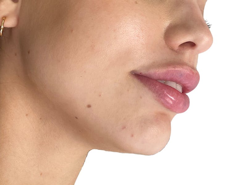 Filler Before & After Gallery - Patient 209881 - Image 2