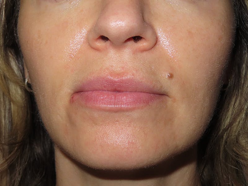 Filler Before & After Gallery - Patient 546830 - Image 1