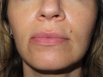 Filler Before & After Gallery - Patient 546830 - Image 1