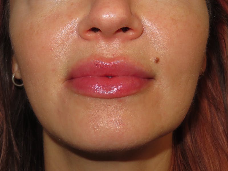 Filler Before & After Gallery - Patient 546830 - Image 2
