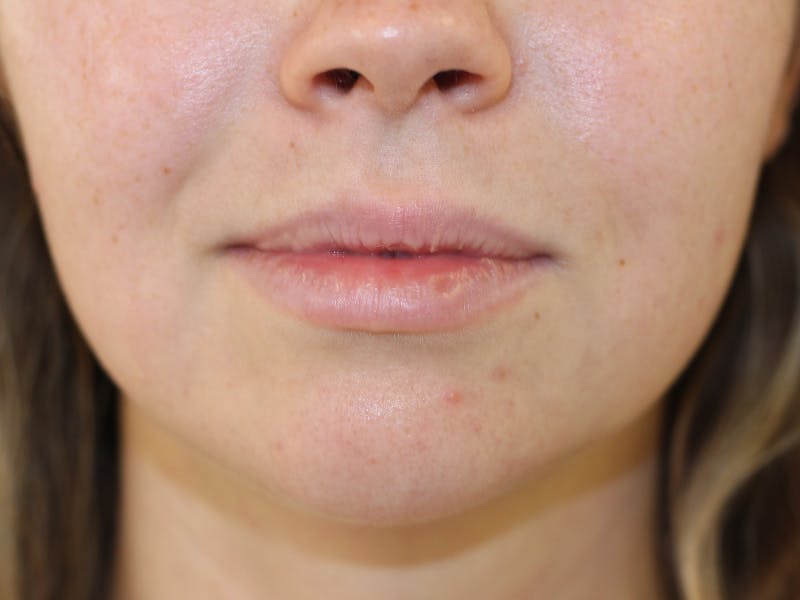 Filler Before & After Gallery - Patient 294241 - Image 1