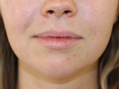 Filler Before & After Gallery - Patient 294241 - Image 1