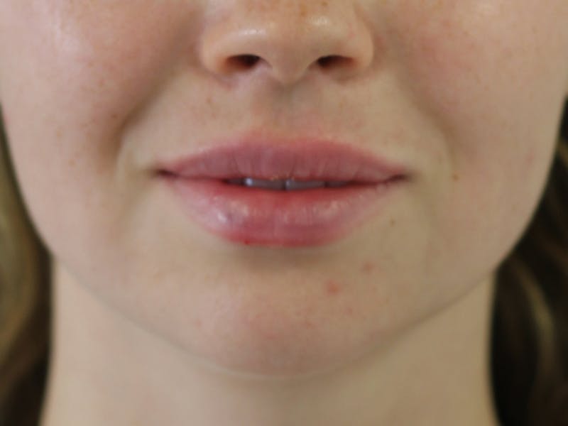 Filler Before & After Gallery - Patient 294241 - Image 2